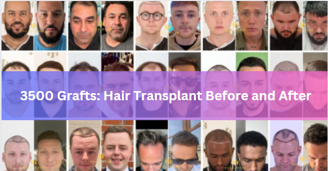 3500 Grafts: Hair Transplant Before and After